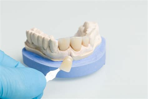 How Dental Crowns Can Transform Your Smile And Confidence