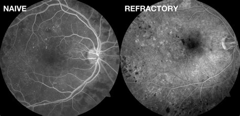 Fluorescein Angiography Images Right Eyes Of Patients With