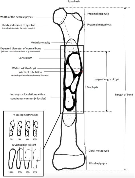 Inter Rater Reliability Of The Radiographic Assessment Of Simple Bone