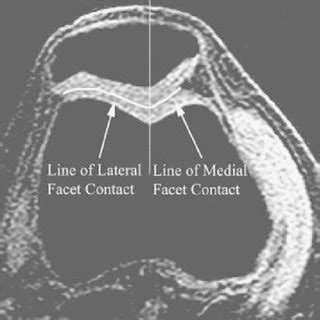 The Method Used To Measure Patellofemoral Contact Area Is Shown The