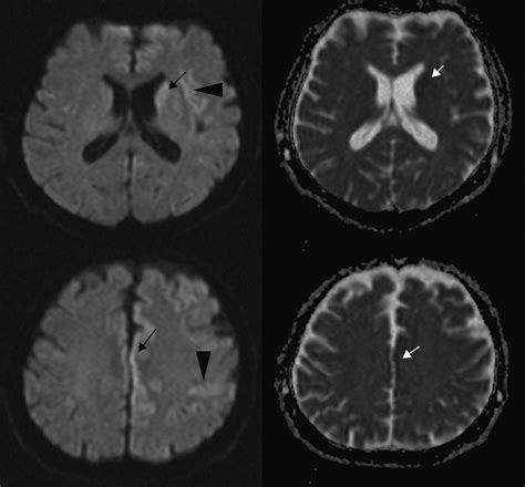 Brain Mri Demonstrates Restricted Diffusion In Bilateral Caudate