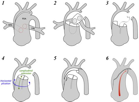 Chimney Reconstruction Of The Aortic Arch In The Norwood Procedure