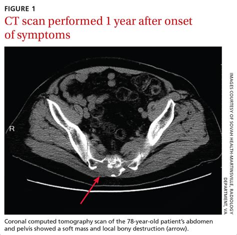 78 Year Old Man • Tail Bone Pain • Unintended Weight Loss • History Of