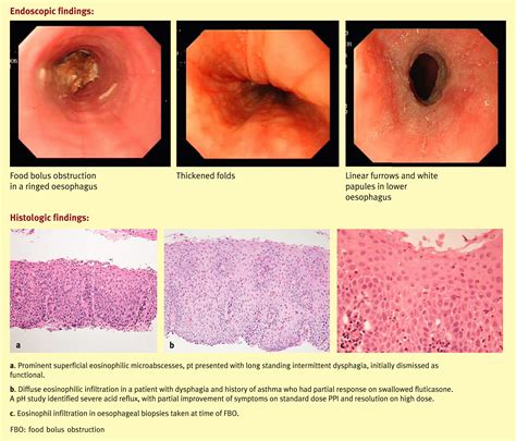 Eosinophilic Oesophagitis And Food Allergy Medicine