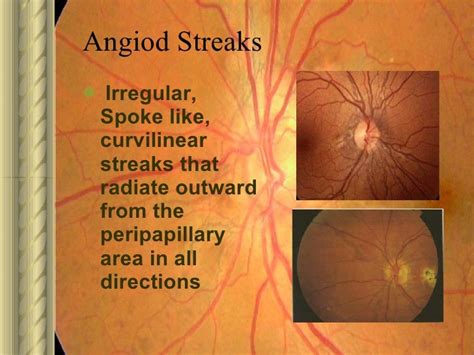 Angioid streaks