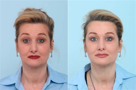 Botox Cosmetic Photos Houston Tx Patient