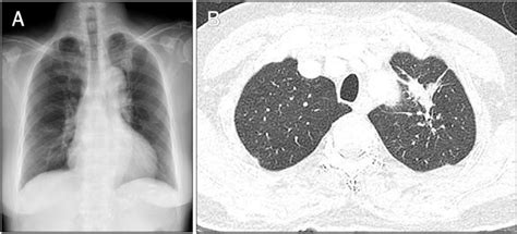 A Chest X Ray Shows Increased Nodular Opacity In Left Upper Lobe B Download Scientific