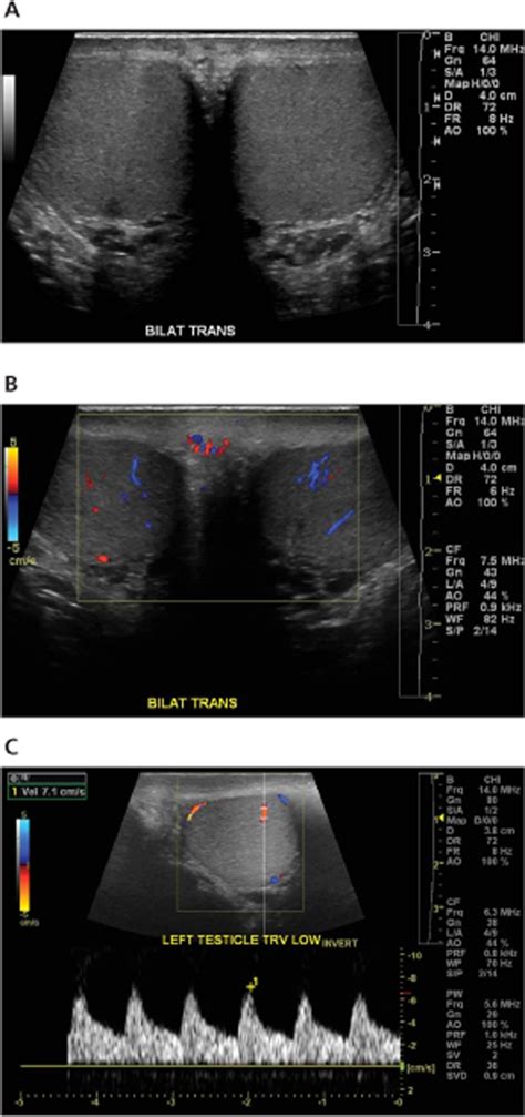 Partial Testicular Torsion Ultrasound