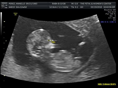 I'm going to be a Mommy!: 13 week Ultrasound Pictures