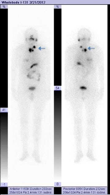 Whole Body Scan Wbs At 48 H After Radioiodine I 131 Therapy Showing