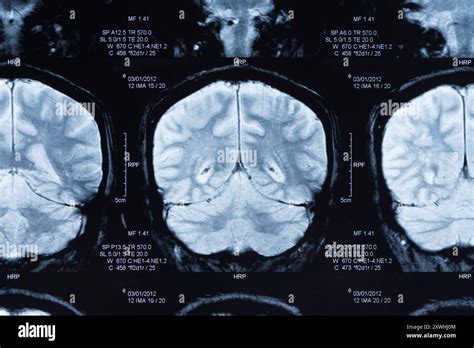 image  brain scan patient  ct scan stock photo alamy