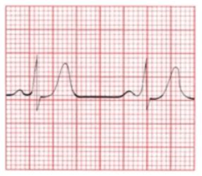 Ekg Strips Part Exam Flashcards Quizlet