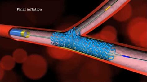 Main Branch Bifurcation Stent PROVISIONAL By Advanced Bifurcation