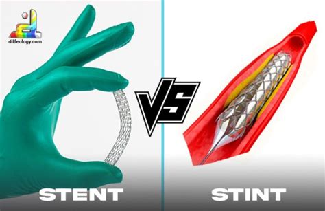 Difference Between Stent And Stint Diffeology