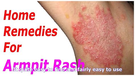 Ten Ways To Eliminate Armpit Rash What Health Tips Youtube