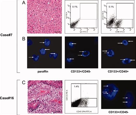 Expression Of The Stem Cell Marker Cd133 In Recurrent Glioblastoma And