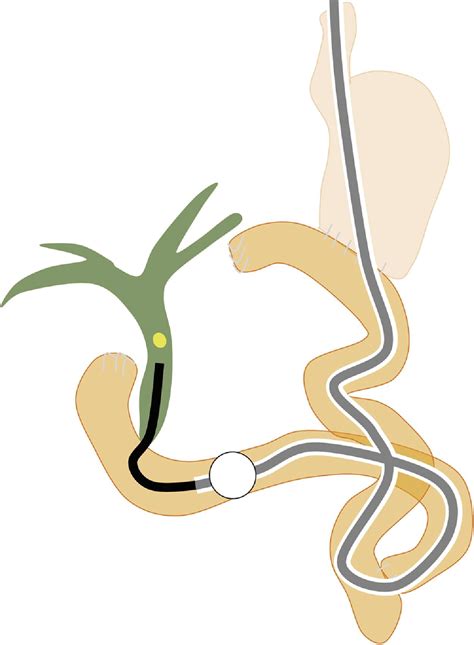 Diagnostic And Therapeutic Peroral Direct Cholangioscopy In Patients