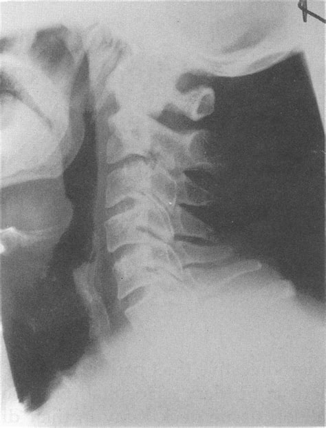 X Ray Soft Tissue Neck Medicalrojak