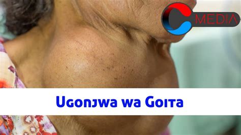 Dalili Za Ugonjwa Wa Goita Symptoms Of Goitre Disease Clever Media