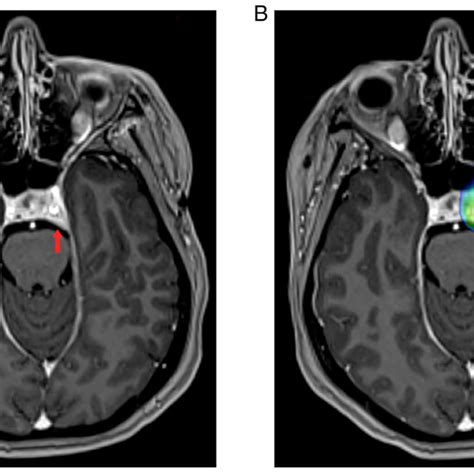 (A) Brain MRI with I/V contrast. The red arrow indicates homogeneous ...