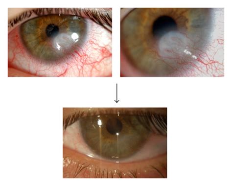 Clinical Evolution Of A Patient With Neurotrophic Keratitis Due To Download Scientific Diagram