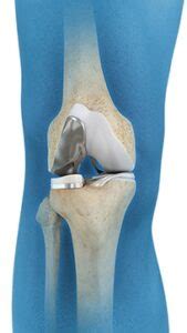 Unicompartmental Knee Replacement Sydney Knee Specialists