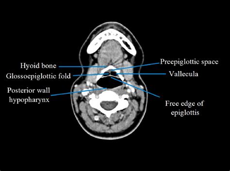 Supraglottic Larynx Anatomy