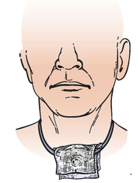 Tracheostomy Procedure Care Tracheostomy Complications