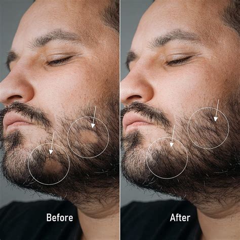 Rogaine Facial Hair Before And After