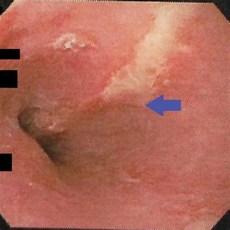 Longitudinal Tear Consistent With Mallory Weiss Blue Arrow