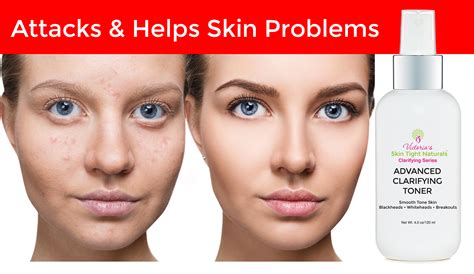 Fix Your Acne Scars Now Skin Tight Naturals