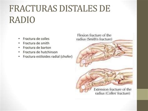 Fracturas De Radio Distal Ppt