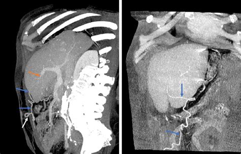 Figure 2 From The Falciform Ligament Region Comprehensive Anatomy And