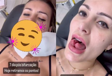 Andressa Urach dá close na língua uma semana após fazer bifurcação