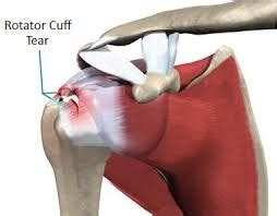 Rotator Cuff Tear - Cryotherapy Denver | 5280 Cryo & Recovery Clinic