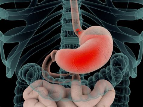 Reflux Ursachen Symptome Behandlung Heilpraxis