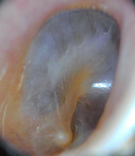 Ear Examination And Wax Removal Hearing Tests Wax Removal And Hearing Aids