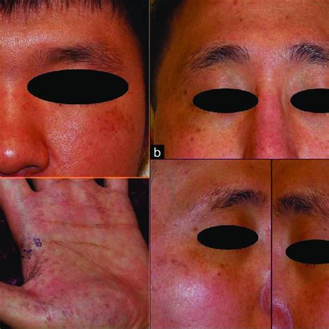 Clinical Characteristics Of Men With Acquired Bilateral Nevus Of