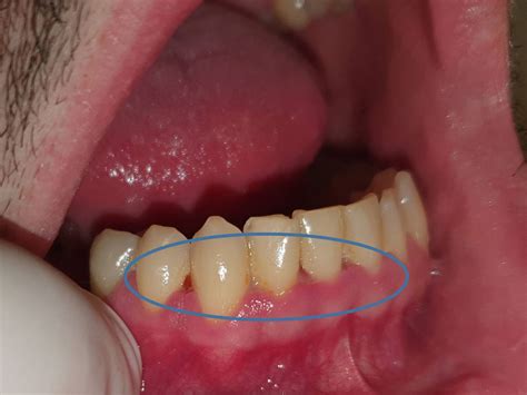 Necrotizing Ulcerative Gingivitis Titsinides Savvas Oral Medicine