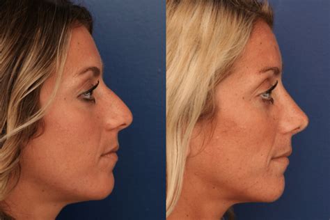 How Much Does A Nose Job Cost With Insurance Detailed Guide