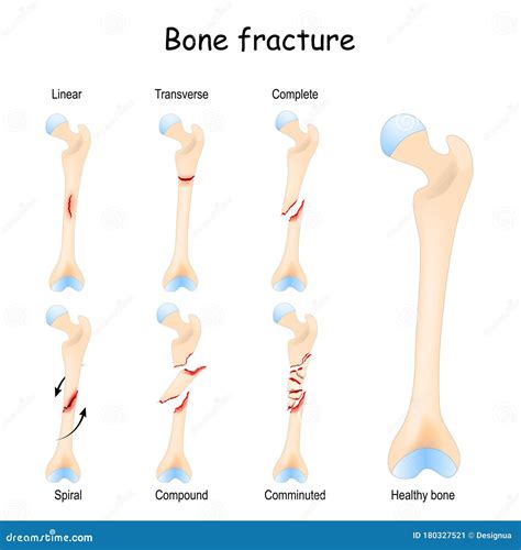 Typical Bone Fractures. Healthy Femur and Leg Fracture in Different ...