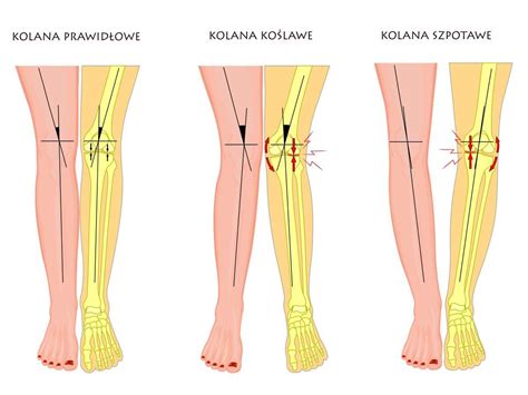 Szpotawe Kolana Leczenie Wiczenia Choroby Polki Pl