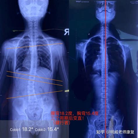 100个脊柱侧弯姿势体态不正纠正案例分析（健行者真实案例，持续更新） 知乎