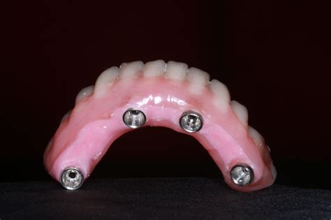 All On X Conversion With Good Fit® Instant Overdenture Get Implant® Llc