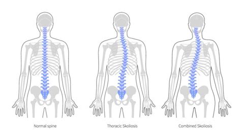 Scoliosis Treatment In Adultsscoliosis Treatment In Adults