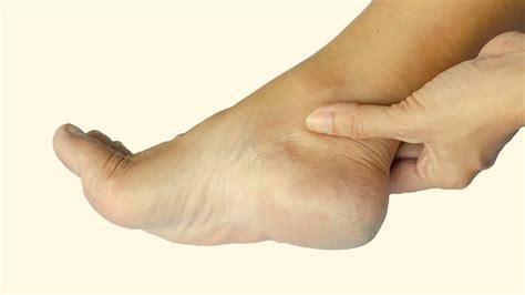 How To Offer Relief To Heel Spur Pain At Home Effectively? | OnlyMyHealth