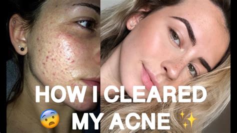 Skincare Routine How I Cleared My Acne Youtube