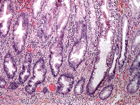 Pathology Outlines - Sessile serrated adenoma