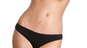 Abdominoplastie Tunisie Tout Savoir Sur L Abdominoplastie