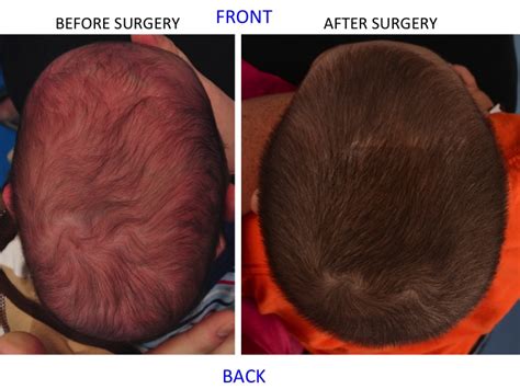 Minimally Invasive Endoscopic Sagittal Strip Craniectomy Before And